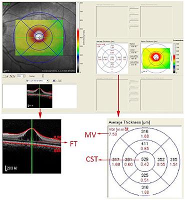 Investigation of Correlations Between Optical Coherence Tomography Biomarkers and Visual Acuity in X-Linked <mark class="highlighted">Retinoschisis</mark>
